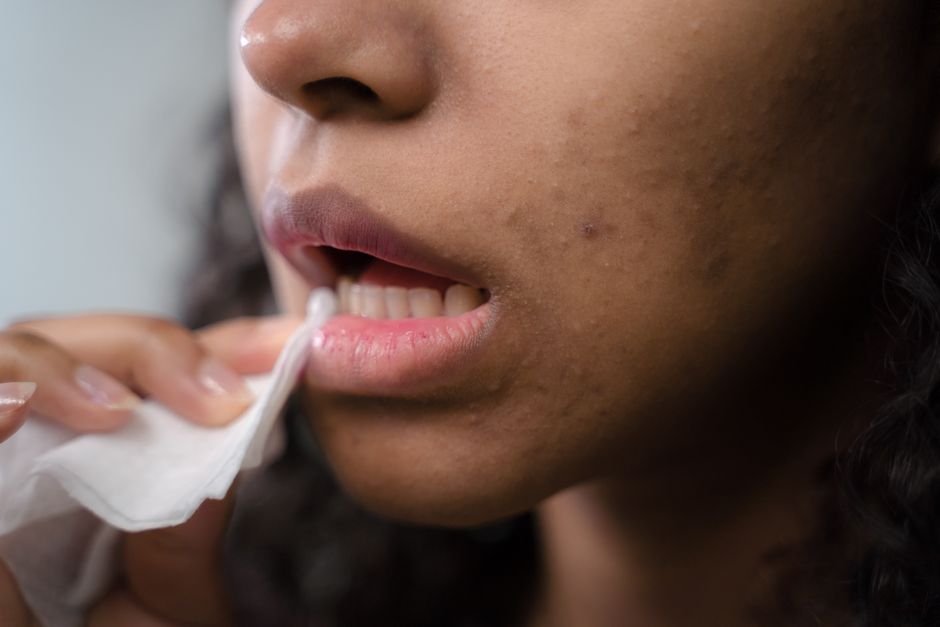 acne treatment skincare medicine telehealth care