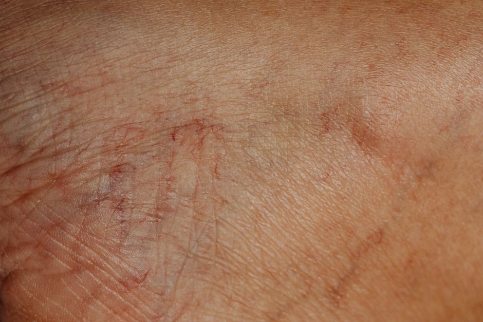 skin condition dermatology closeup telehealth care